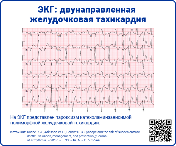 ЭКГ двунаправленная желудочковая тахикардия